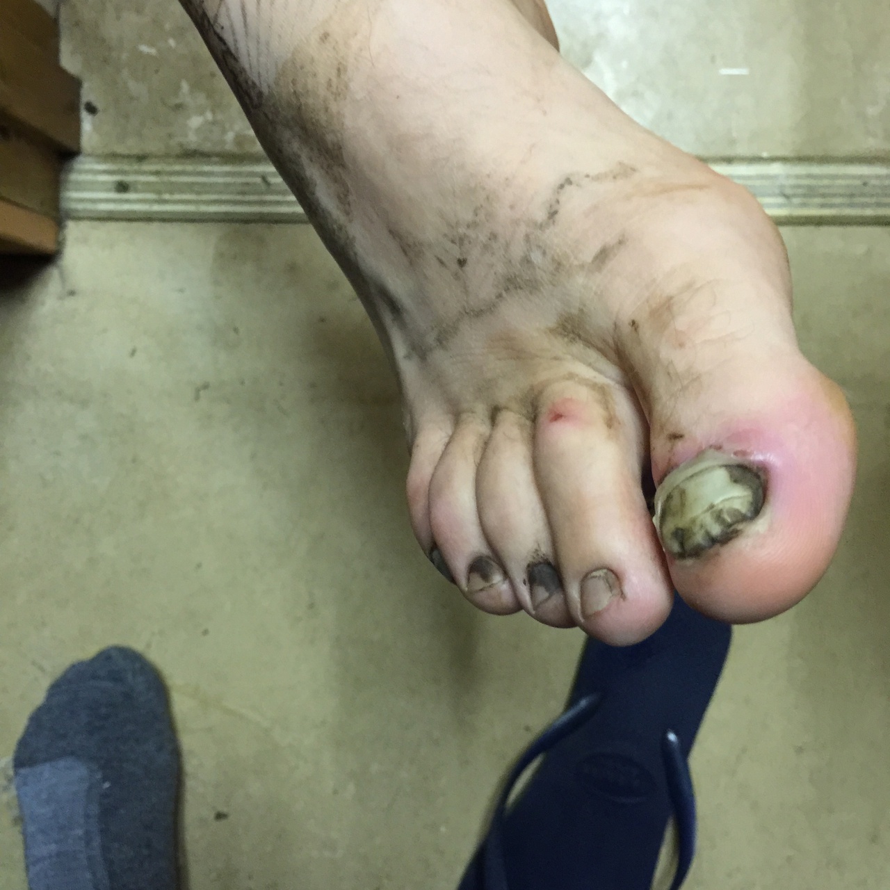 picture of a swollen foot