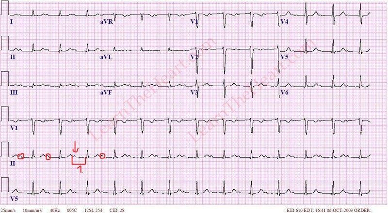 ekg elektródák felhelyezése